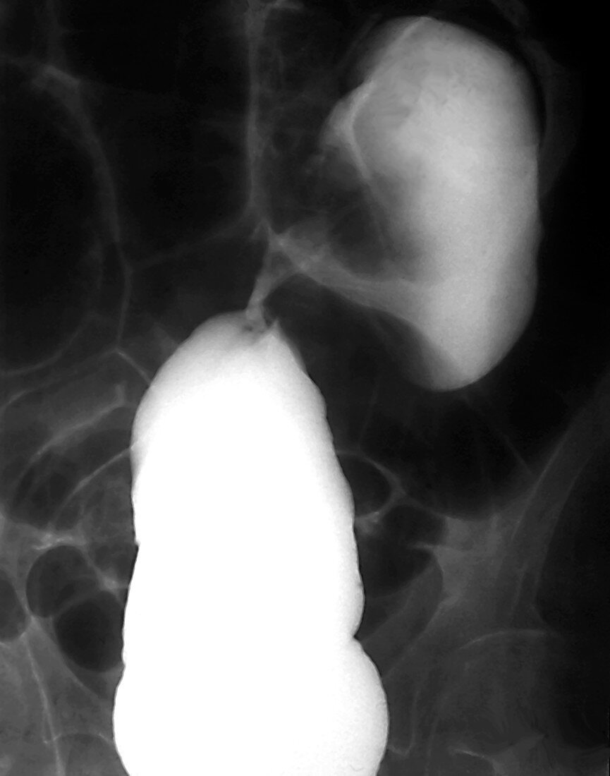 Twisted sigmoid colon,X-ray