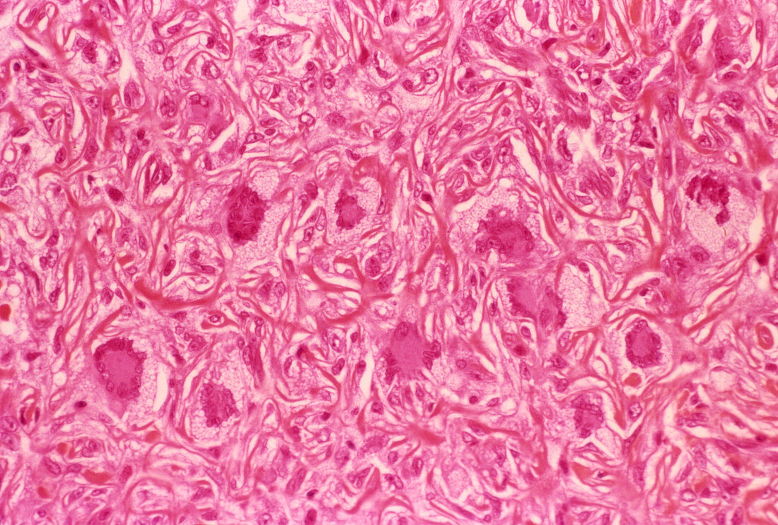 Fatty tumour,light micrograph