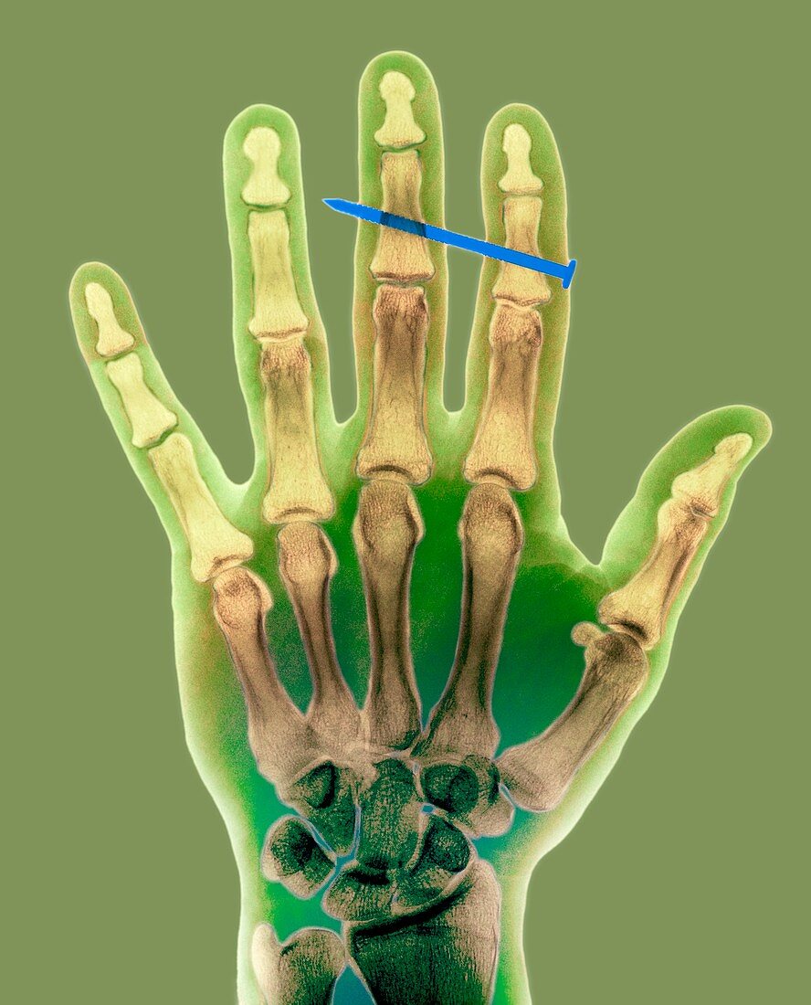 Nail in fingers,X-ray