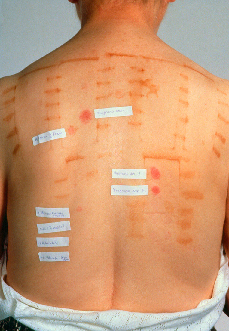 The results of a patch test on a patient's back
