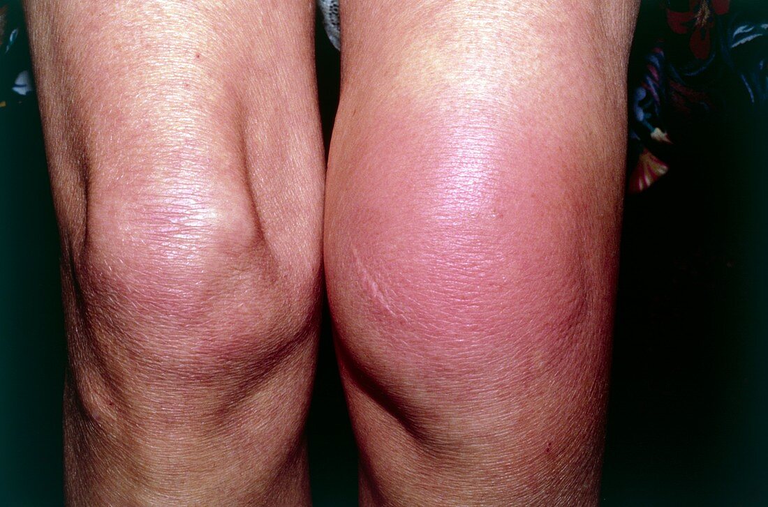Allergic reaction to insect bite on knee