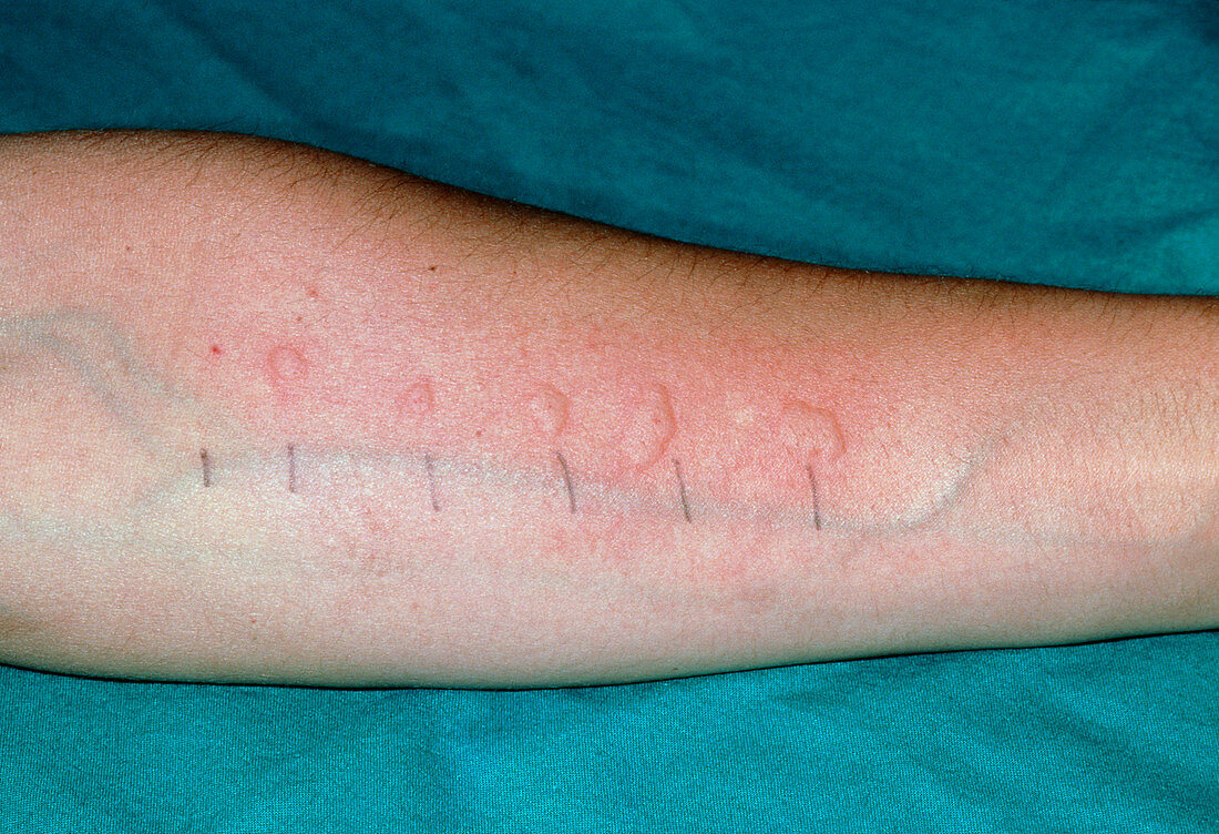 Skin prick test for allergens on a patients arm