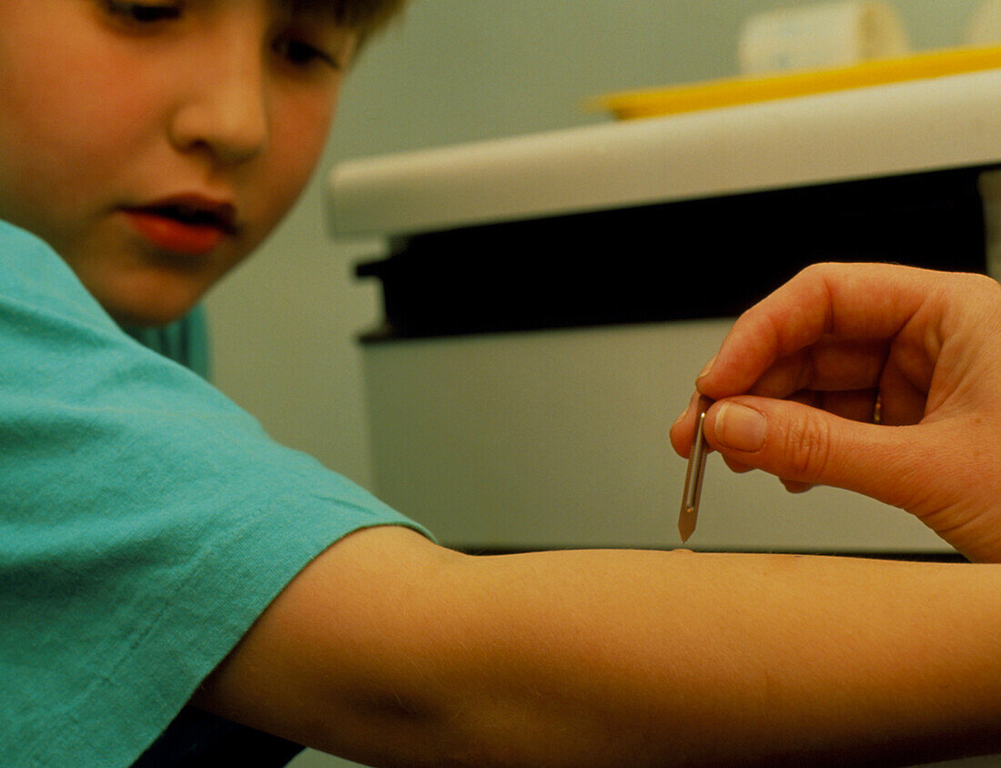 Skin prick test for allergens on a child's arm