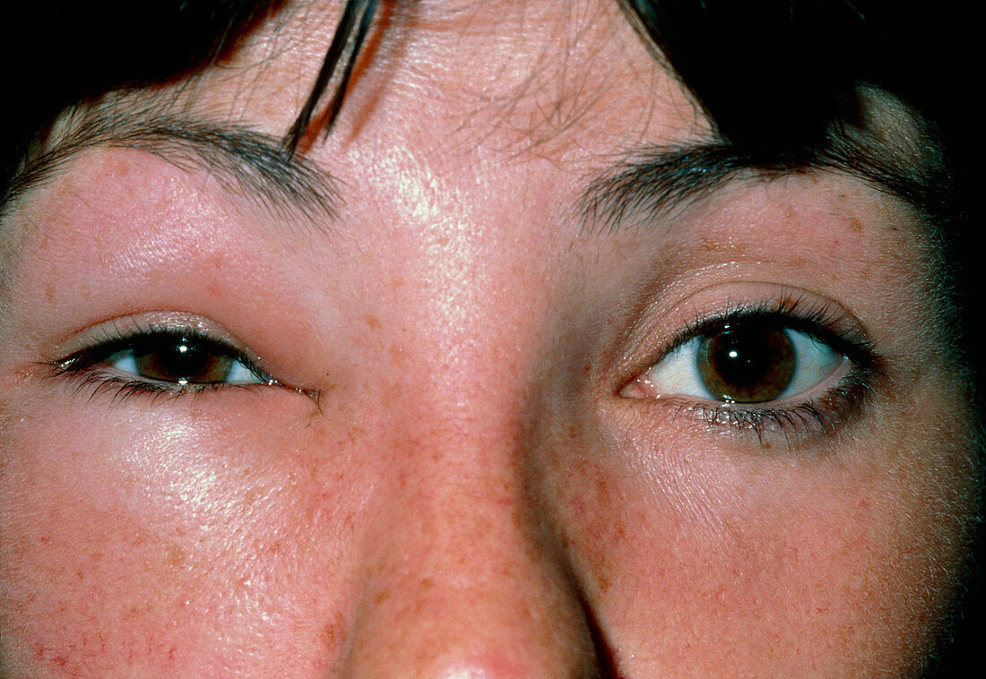 Oedema around the eye due to a bee sting