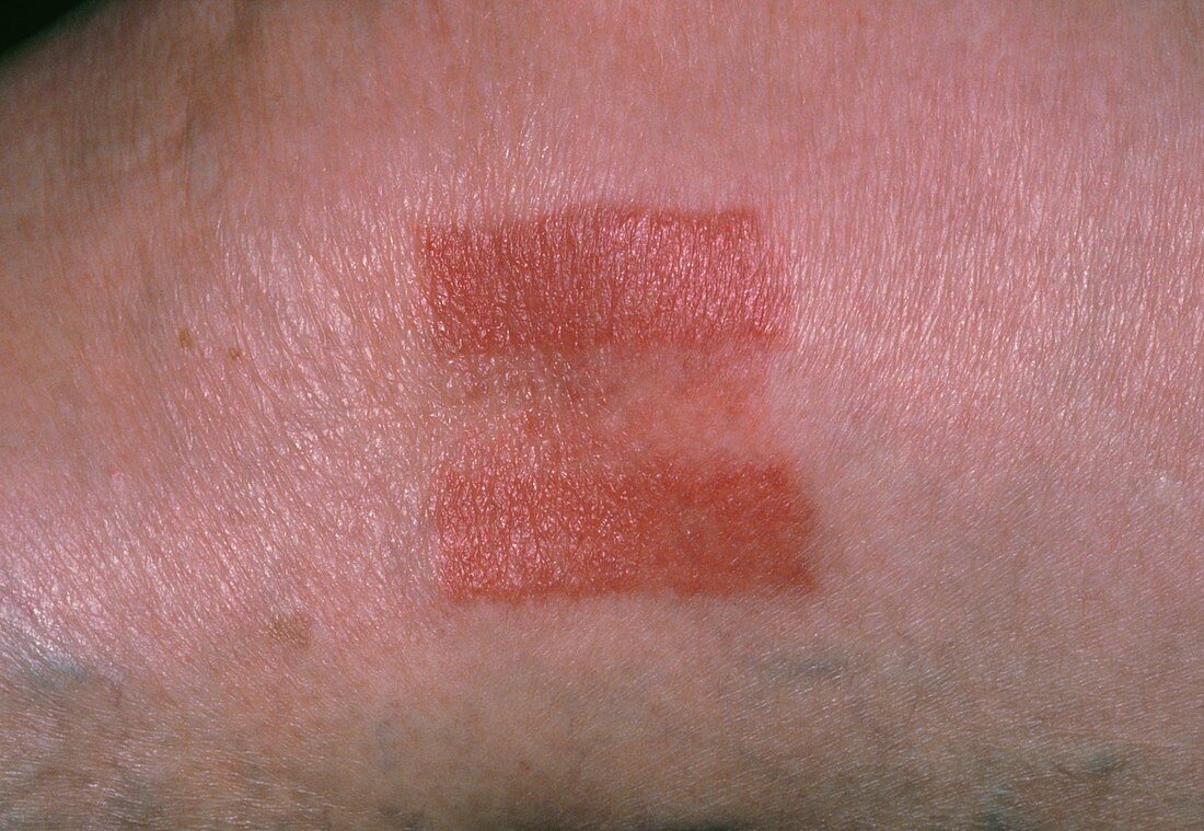 Skin rash caused by allergy to elastoplast