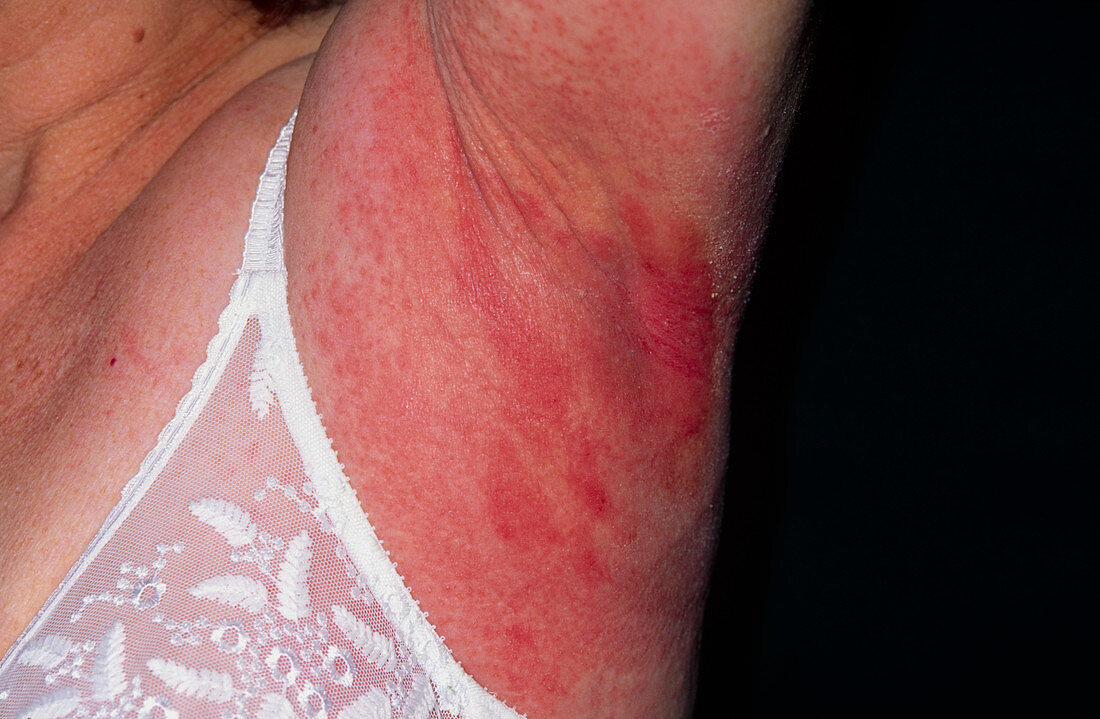 Allergic reaction to armpit deodorant
