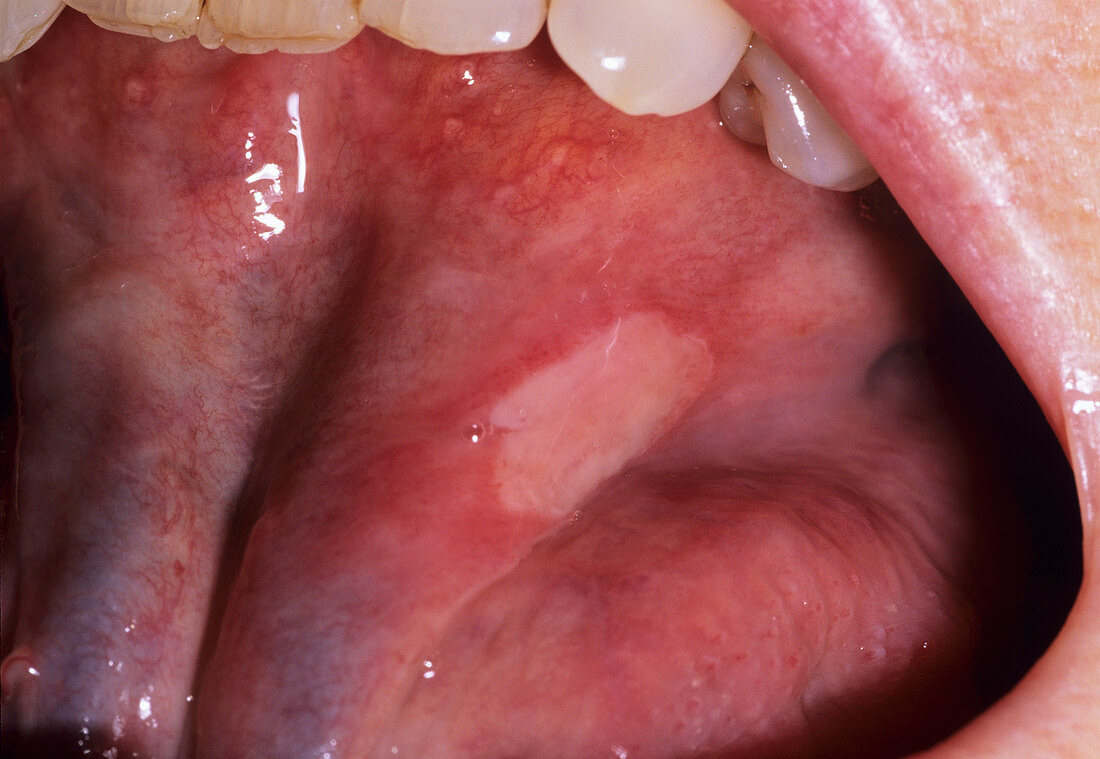 Major aphthous ulcer
