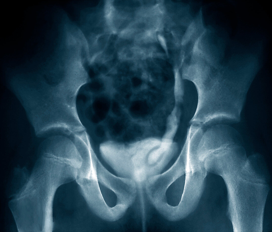 Ureterocele,X-ray