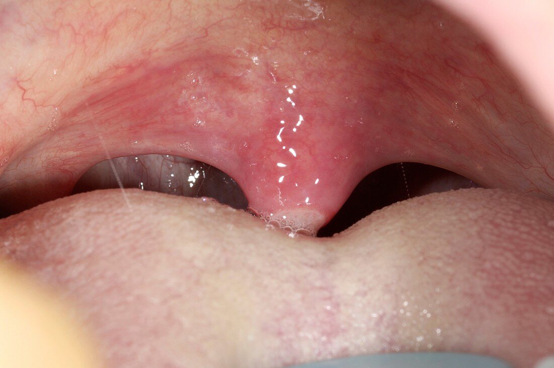 Mouth ulcer