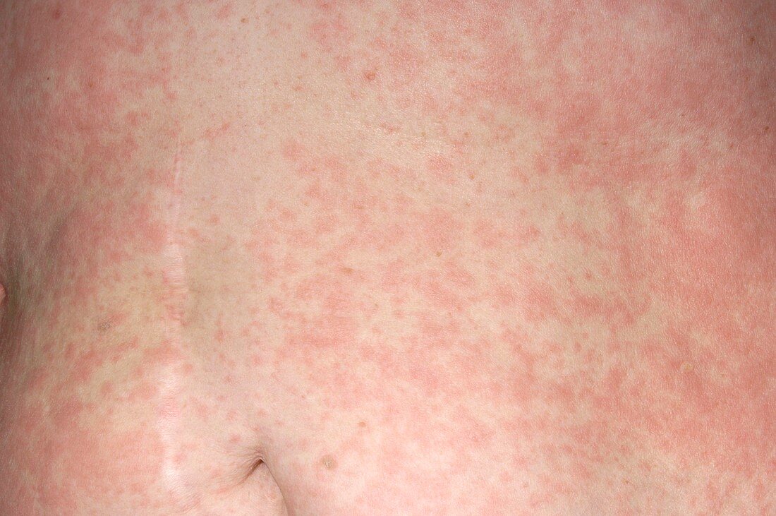 Urticaria rash on abdomen