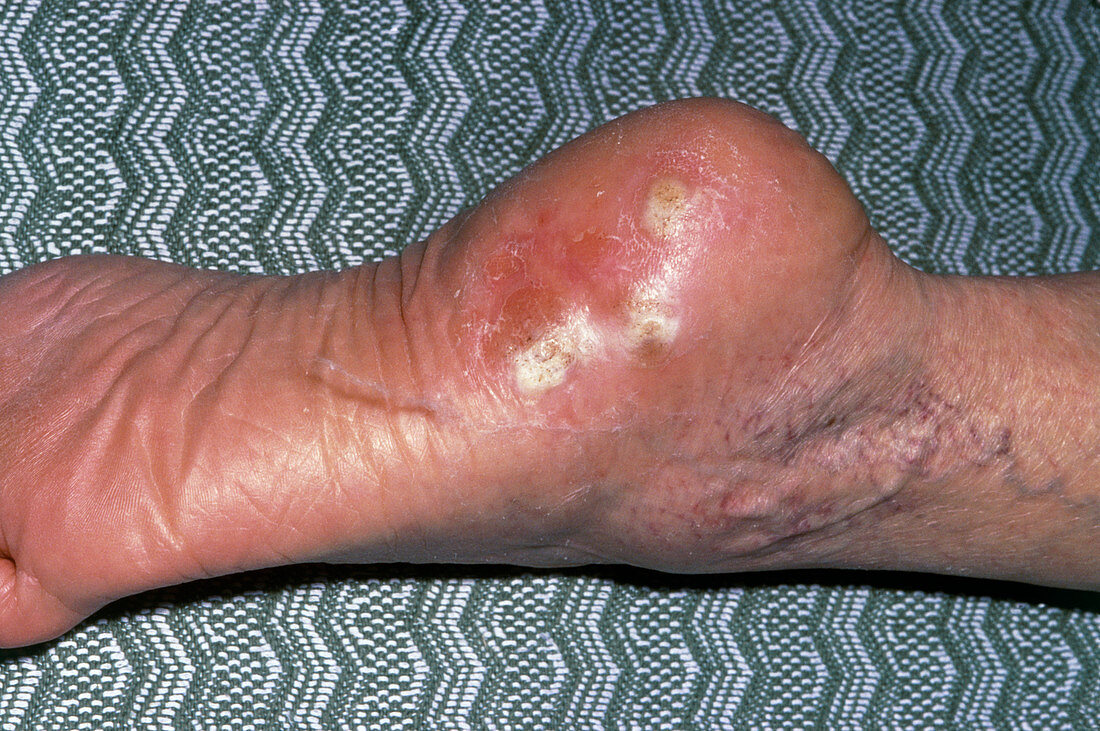 Verrucae affecting heel of the foot