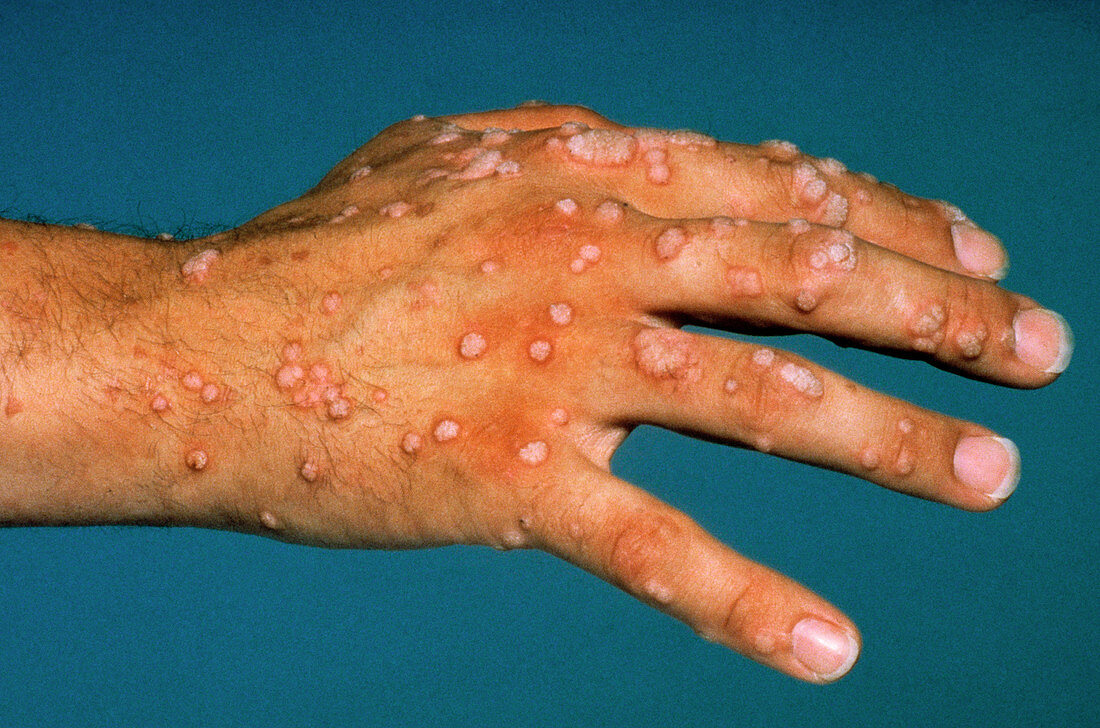 Rash of warts on a man's hand & fingers