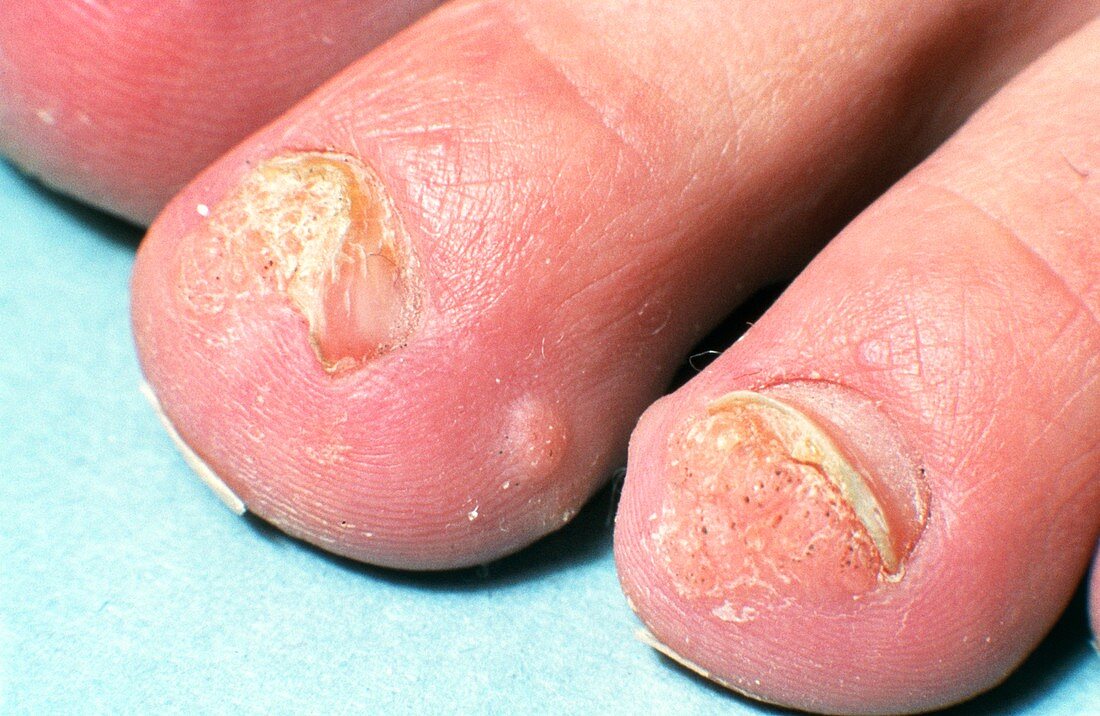 Warts on young man's toes