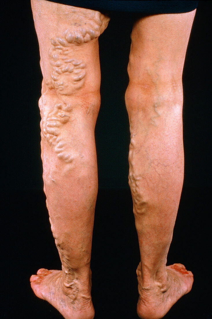Varicose veins with ulceration of toes