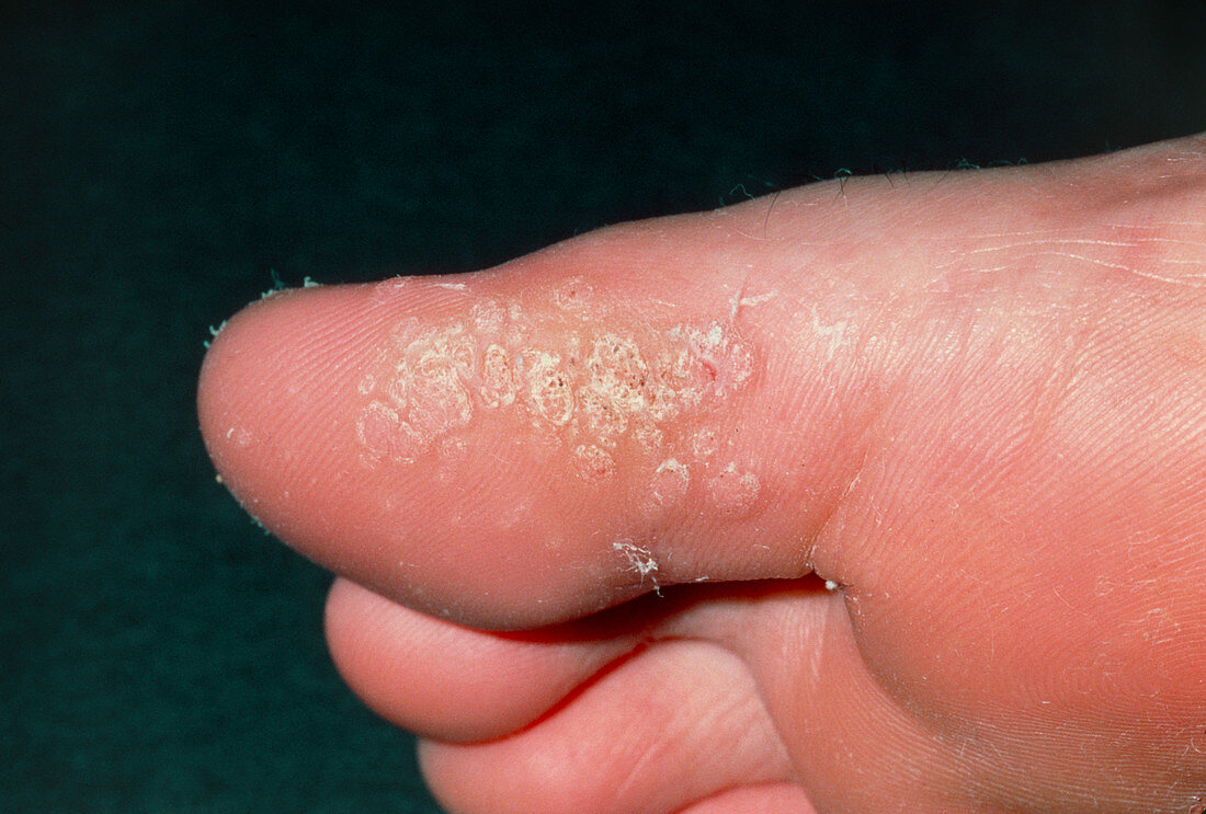 Close-up of plantar warts on big toe
