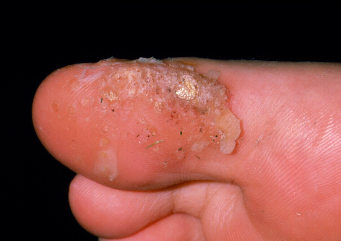 Verrucas (warts) on a patient's big toe