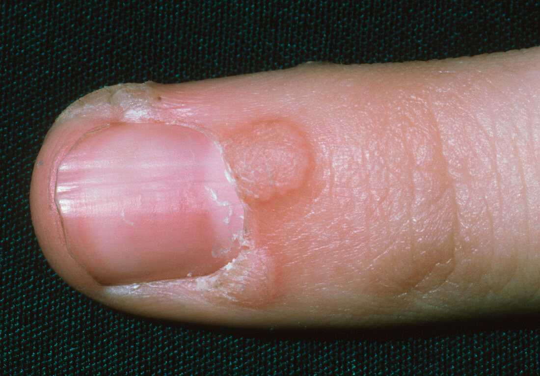 Close-up of wart (verruca) on finger