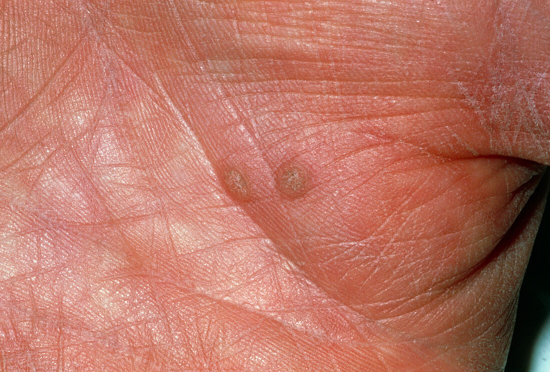 View of two warts on the palm of a hand