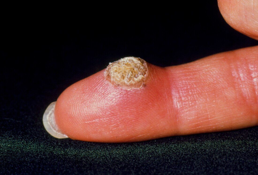 View of a large wart on a woman's finger