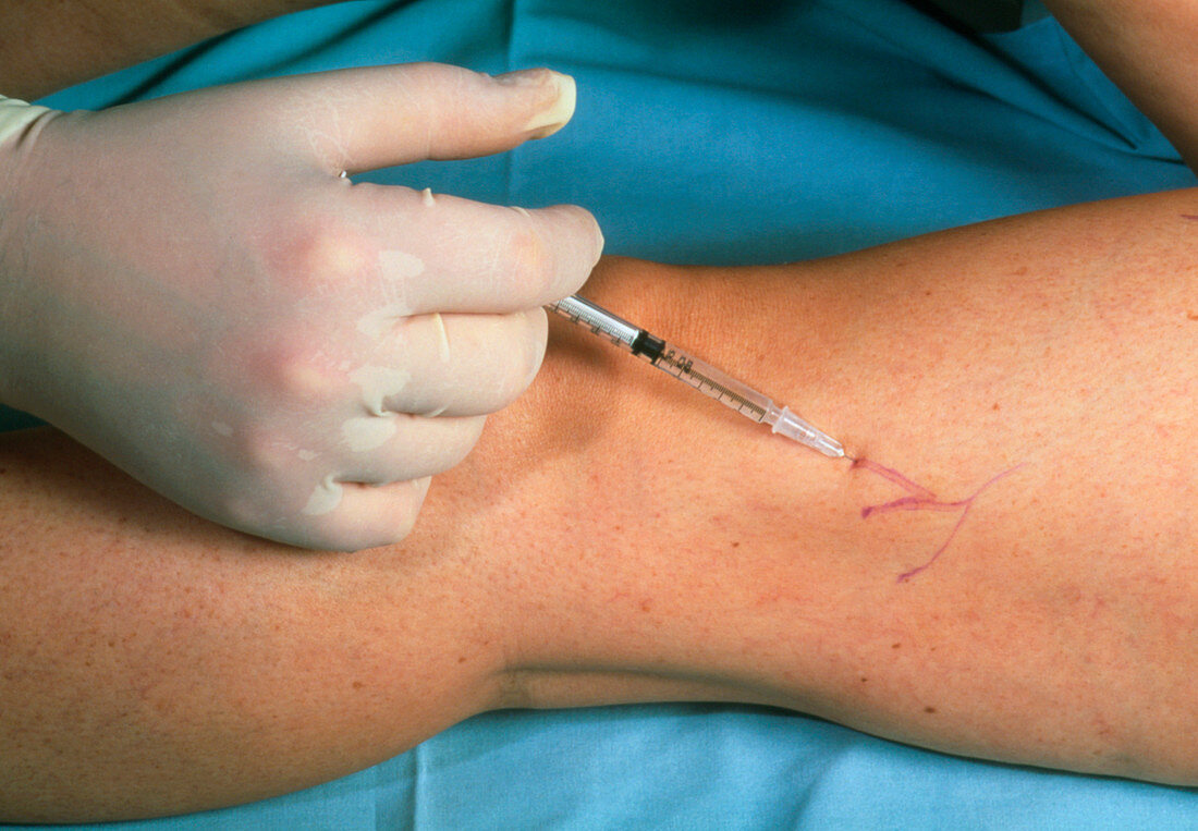 Sclerotherapy for varicose veins