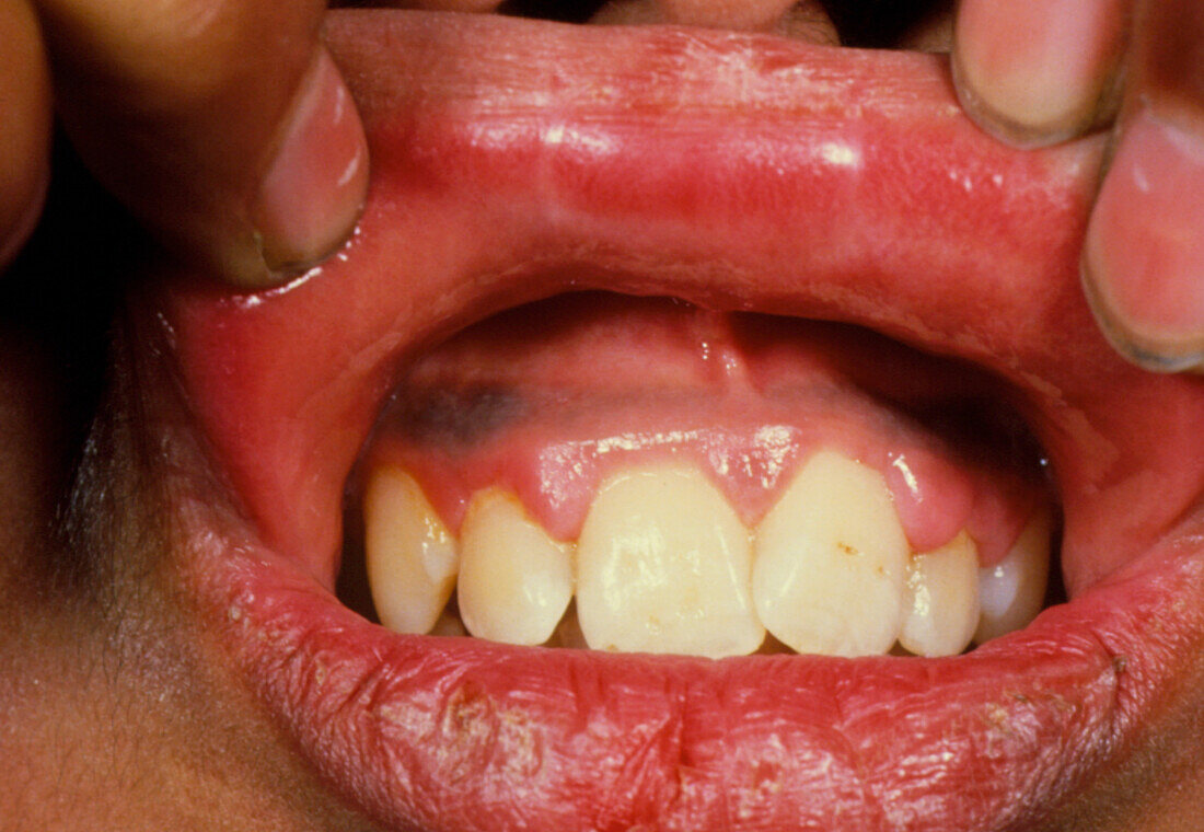 Lead lines on gum due to lead poisoning