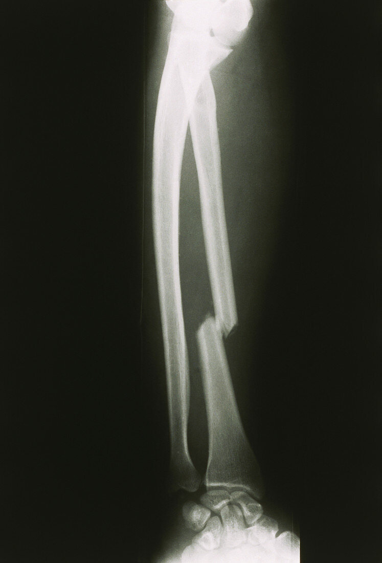 X-ray of the right forearm showing radius fracture
