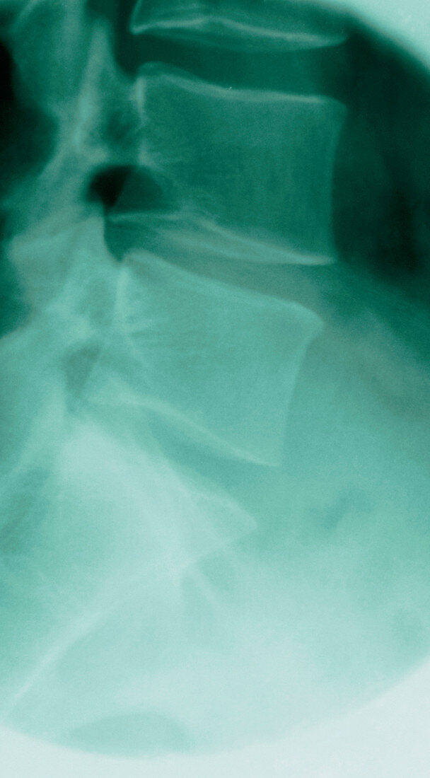 X-ray of the lumbar spine (slipped disc)