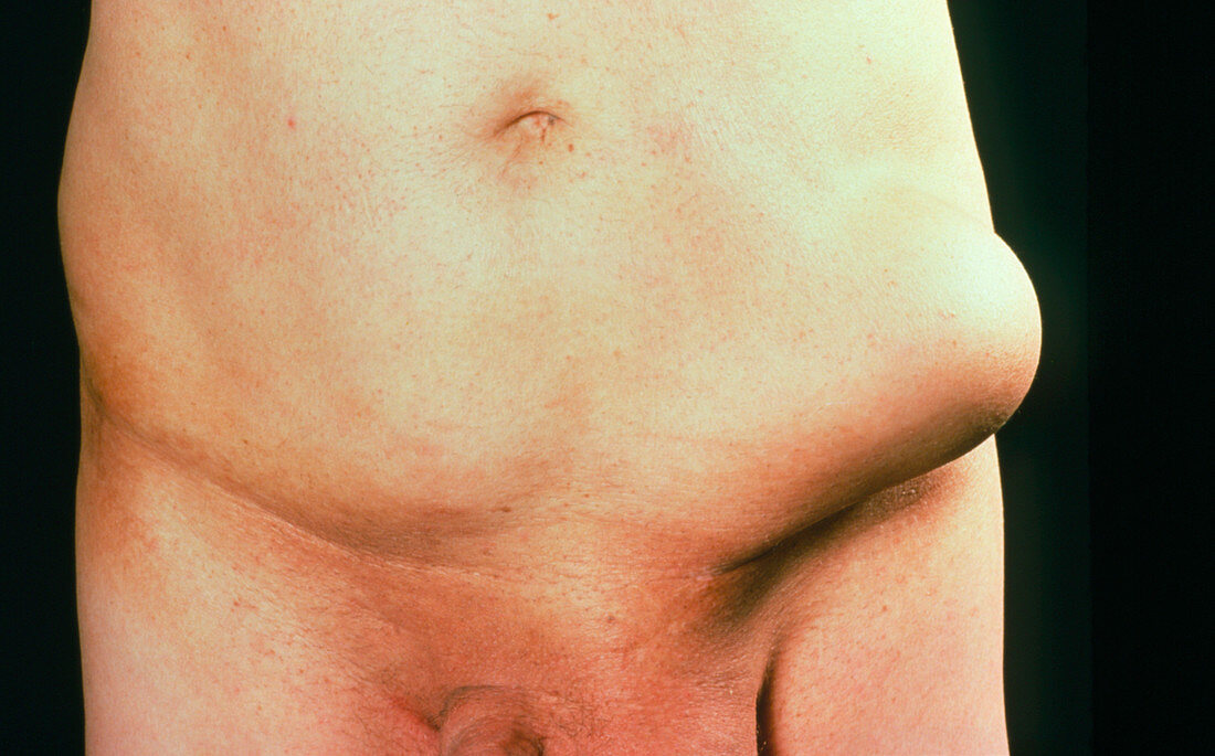 Man with indirect inguinal hernia