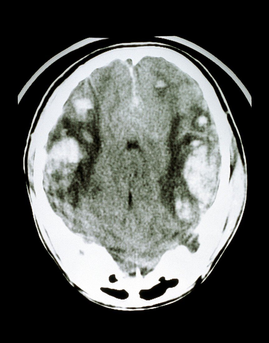 Head injury: CT scan of bitemporal haemorrhage