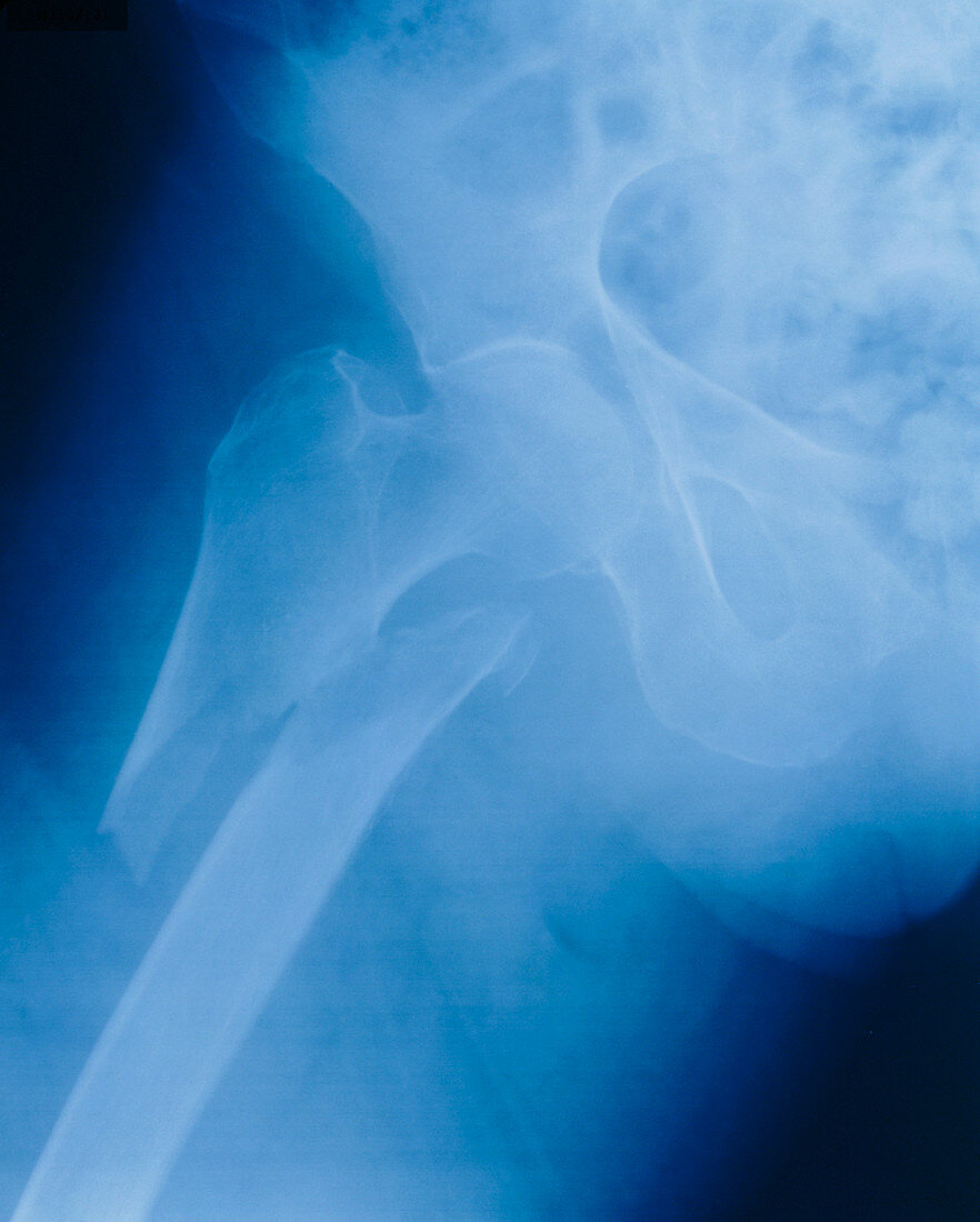 Fractured hip: X-ray of fractured femoral head