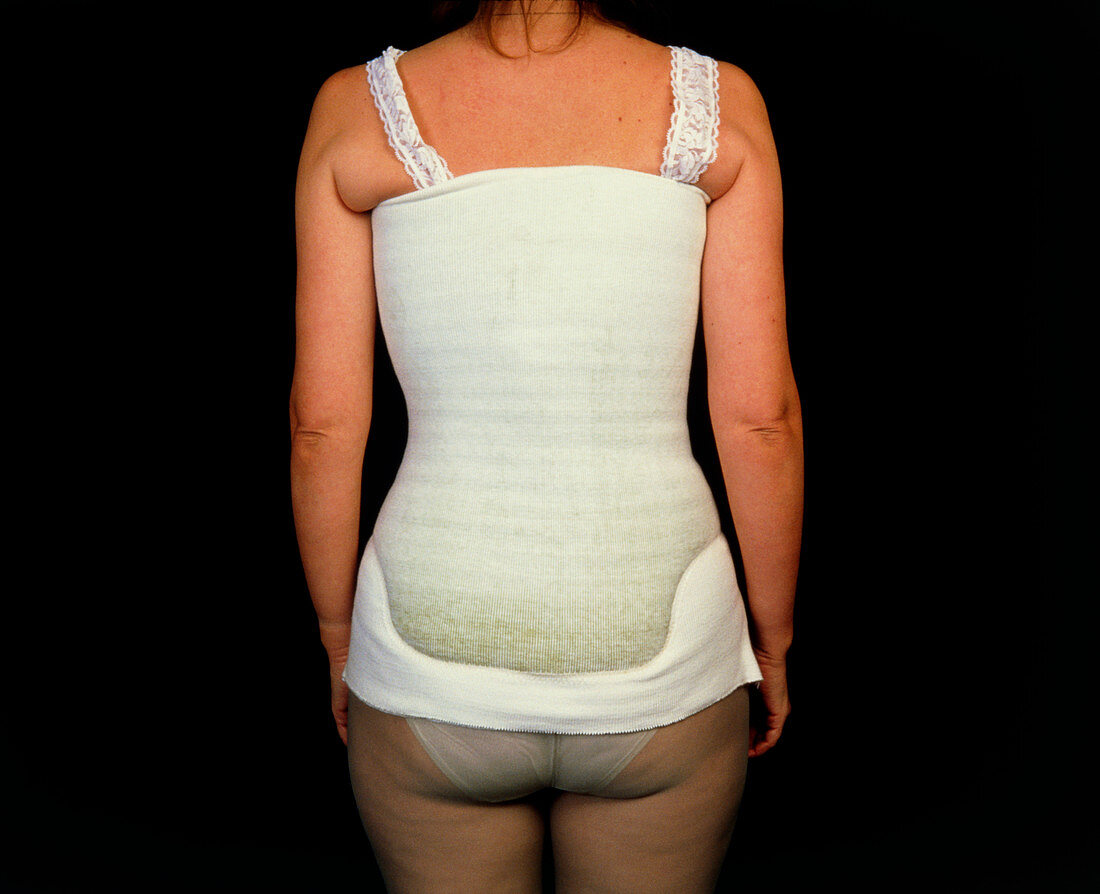 Orthopaedic corset worn on a woman (rear view)