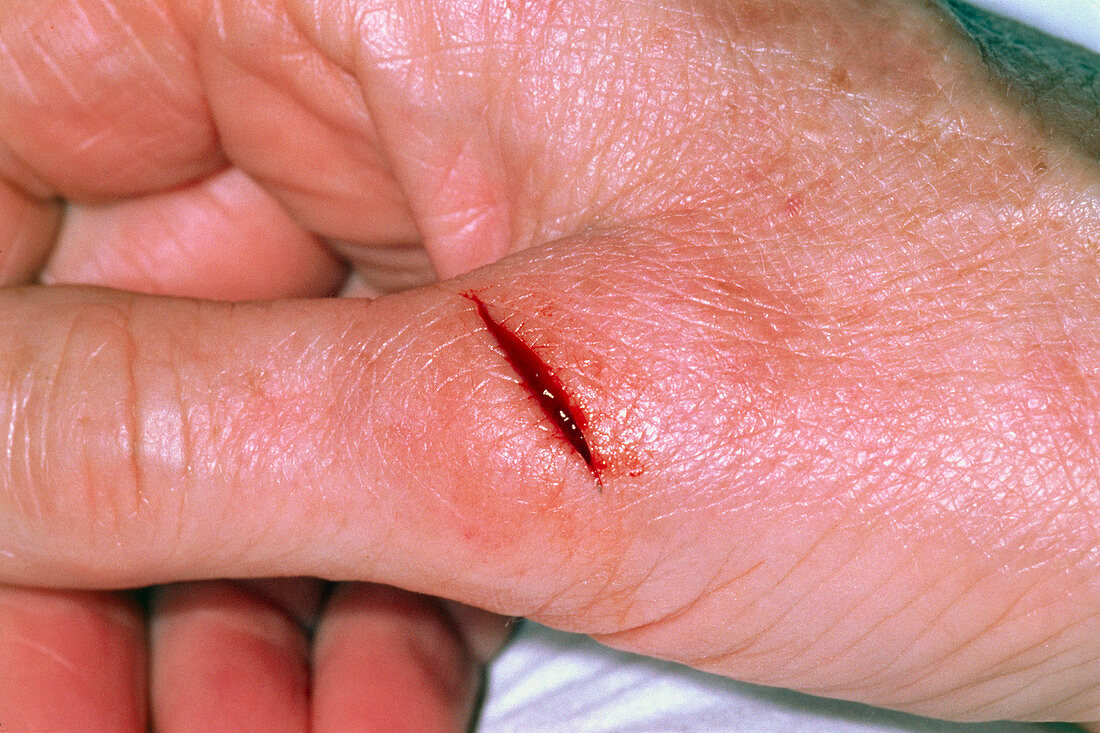 Deep cut to the thumb