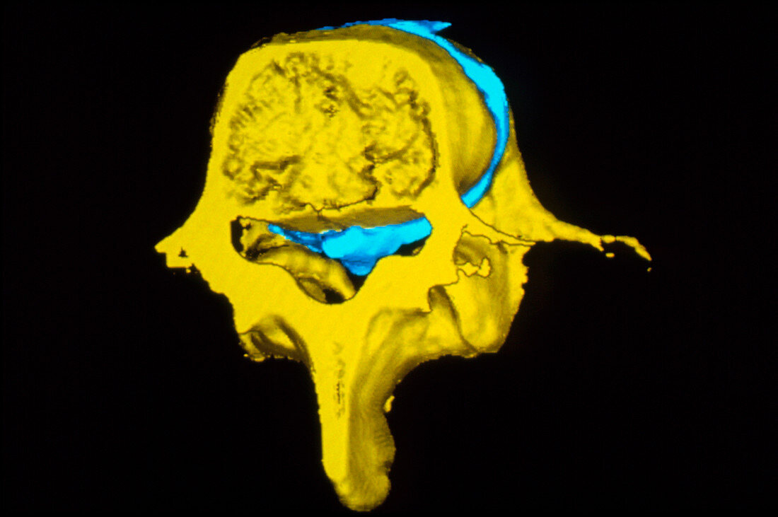 False-colour 3-D CT scan: slipped lumbar disc