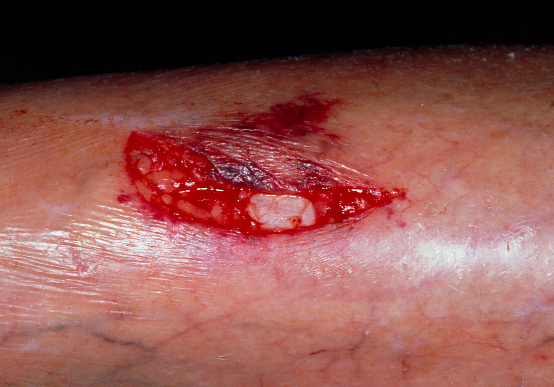 Laceration on the shin of an elderly woman