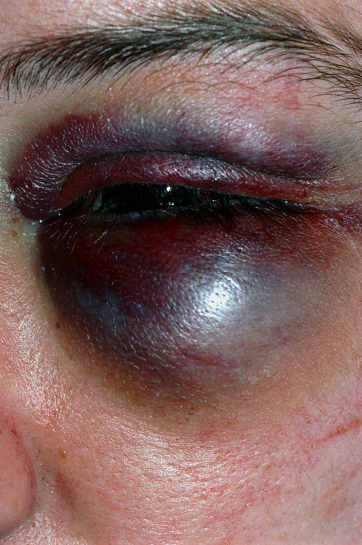 Man suffering from a black eye
