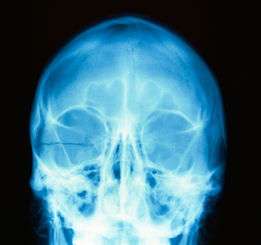 X-ray image of a fractured skull