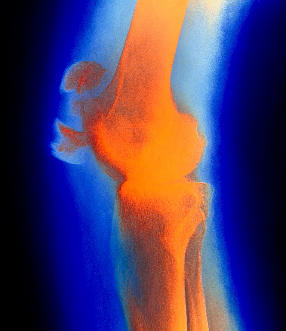 Coloured X-ray image of a fractured kneecap