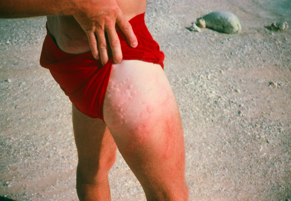 Rash from jellyfish stings on a man's upper leg