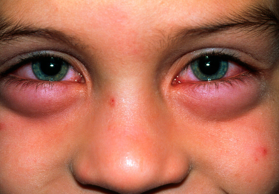 Child with swollen eyes from an allergic reaction