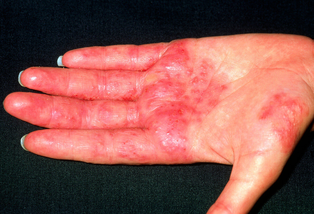 Hairdresser hand with contact dermatitis