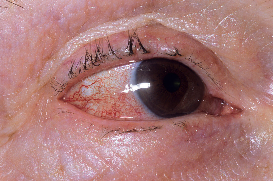 Allergic reaction on the eye