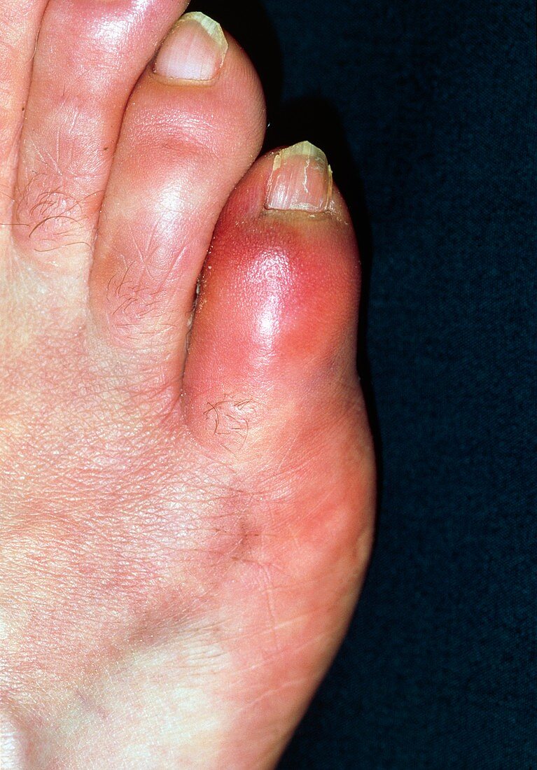 Close-up of red and swollen fractured little toe