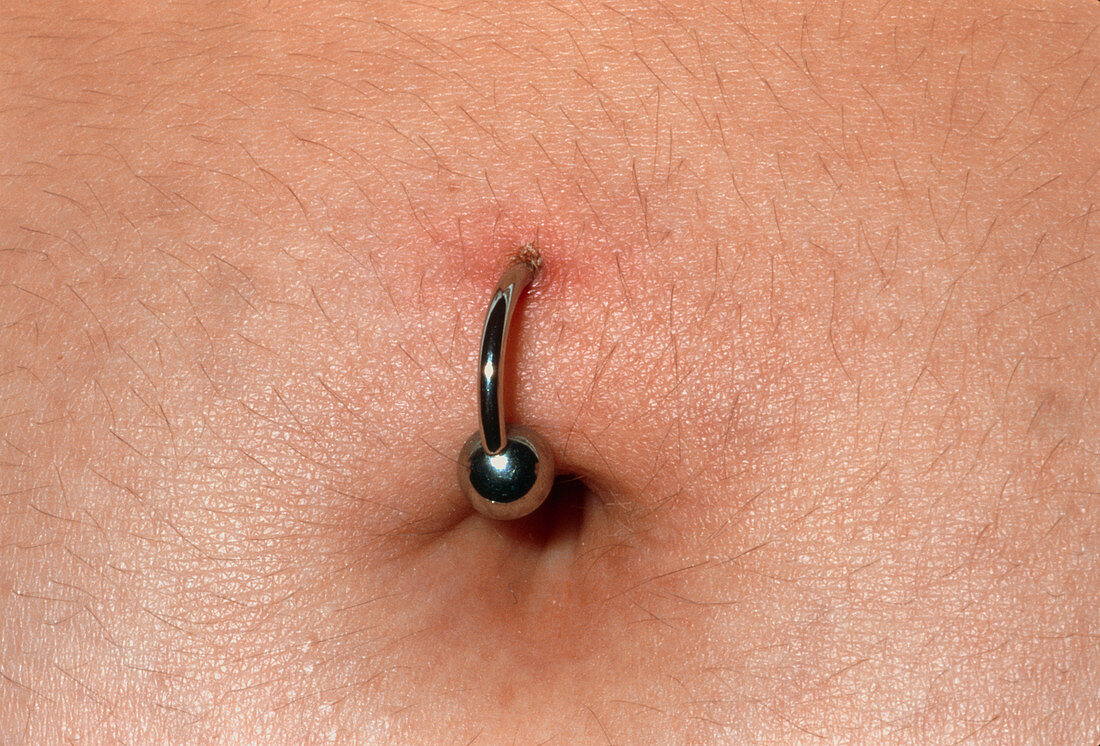 Umbilical infection due to body piercing