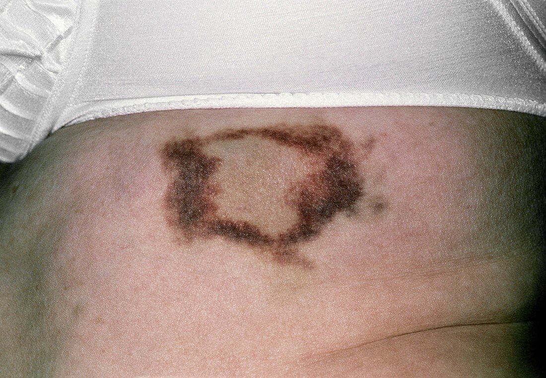 Bruise over a fractured rib on an elderly woman