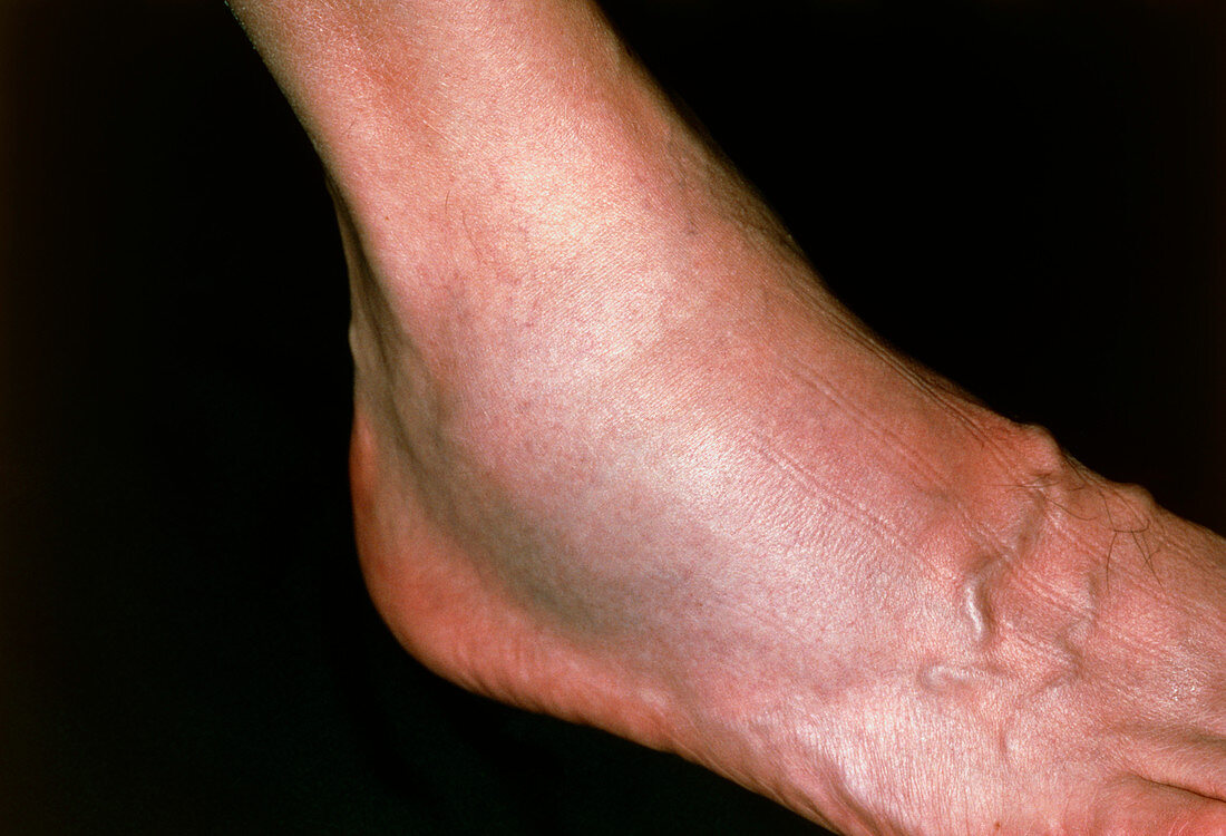 Close-up of swollen ankle due to fibula fracture