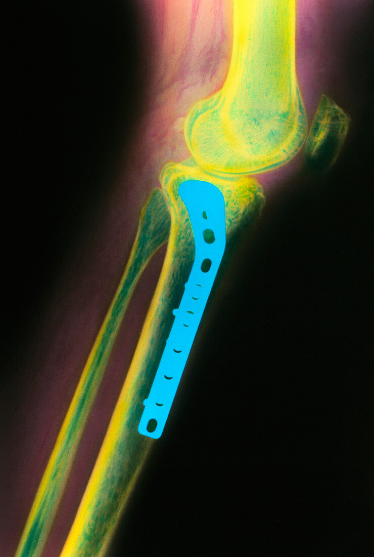 Coloured X-ray of a pinned tibia (lower leg bone)