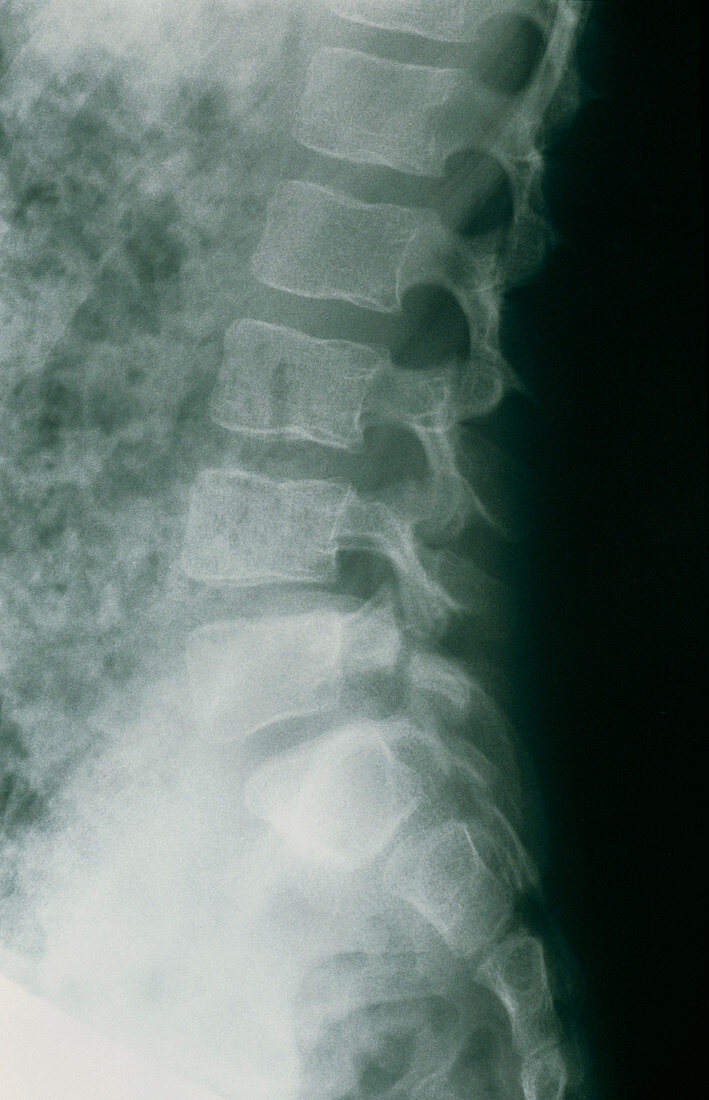 X-ray of spondylolisthesis (slipped vertebra)