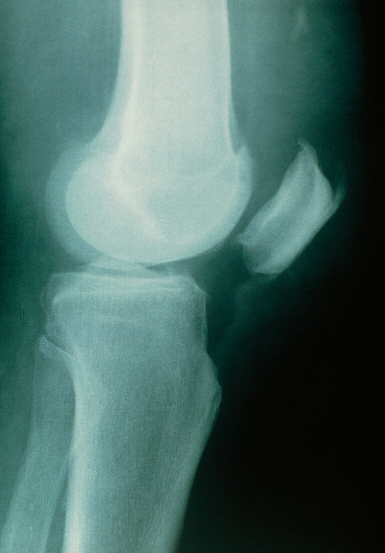 X-ray of a knee with a ruptured patellar tendon