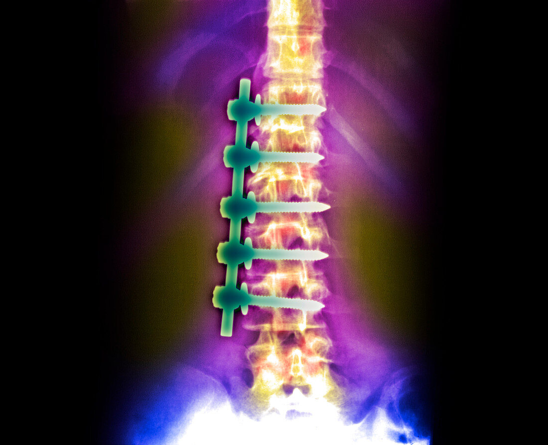 Coloured X-ray of corrected scoliosis of the spine