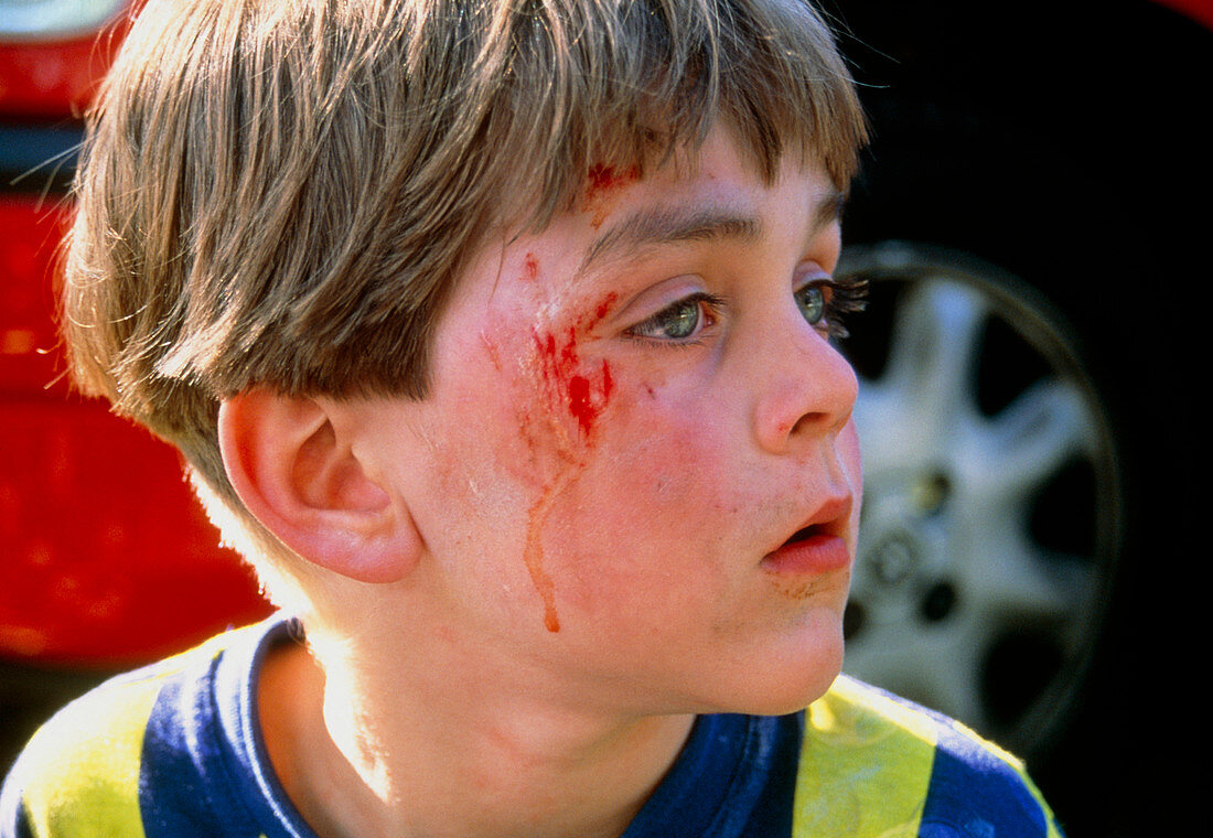 Laceration on the face of a 5-year-old boy